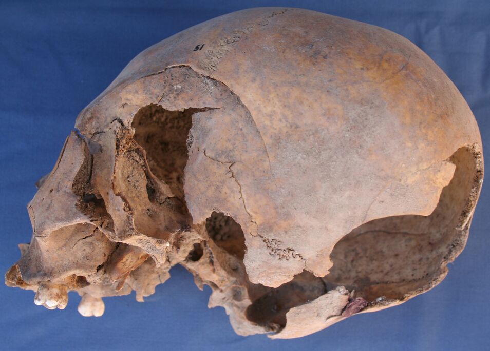 A skull is laying on it's side with the left side facing up. The bone is missing starting on the side of the head going towards the back.